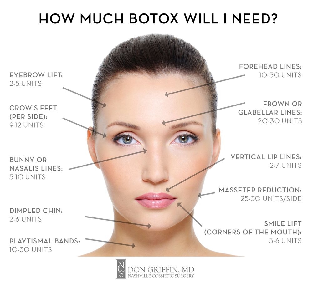 Printable Botox Injection Face Map Printable Botox Injection Face Map
